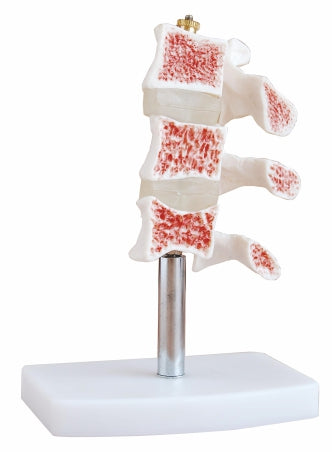 Cutaway Osteoporosis XC-134